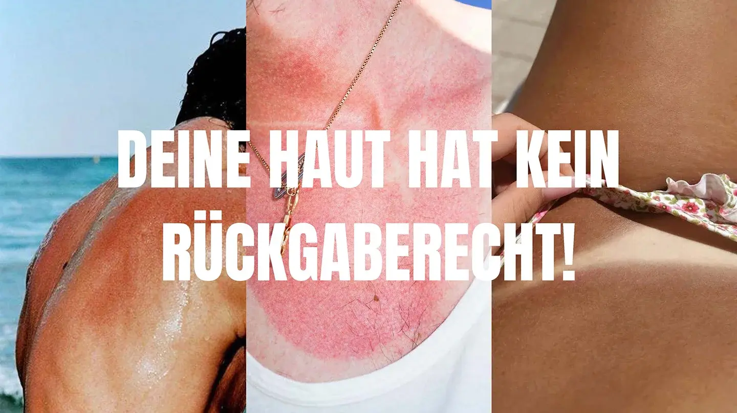 Sunburn marks on the bodies of three different people.